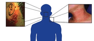 Photo courtesy of CDC